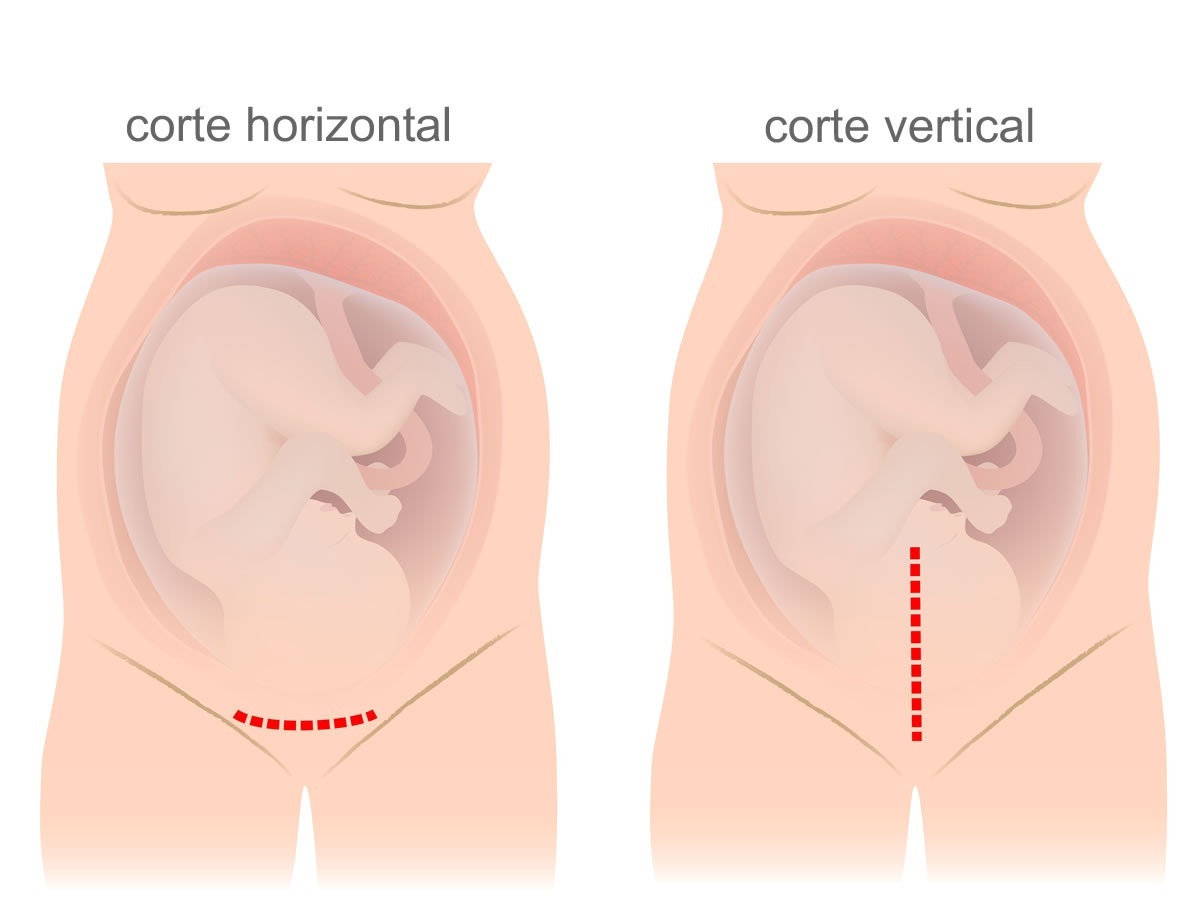 Parto Cesárea Guia Do Bebê 