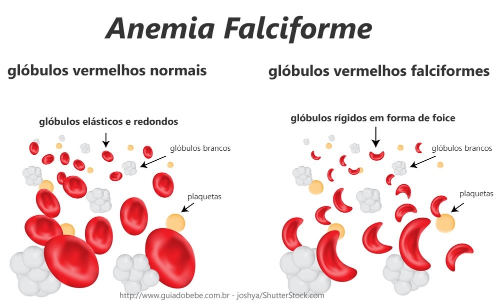 Anemia Falciforme Guia do Bebê