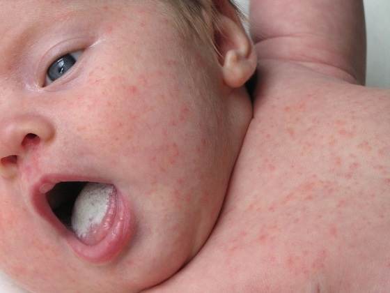 Roseola Ou Exantema Subito Em Bebes E Criancas Guia Do Bebe