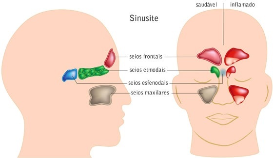 Ilustração sobre sinusite e seios da face - Foto: Alila Medical Media/ShutterStock.com