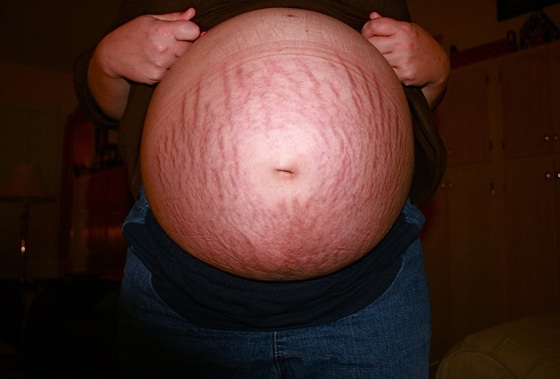 estrias, inchaço e manchas durante a gravidez - Foto: Saildancer / pixabay.com