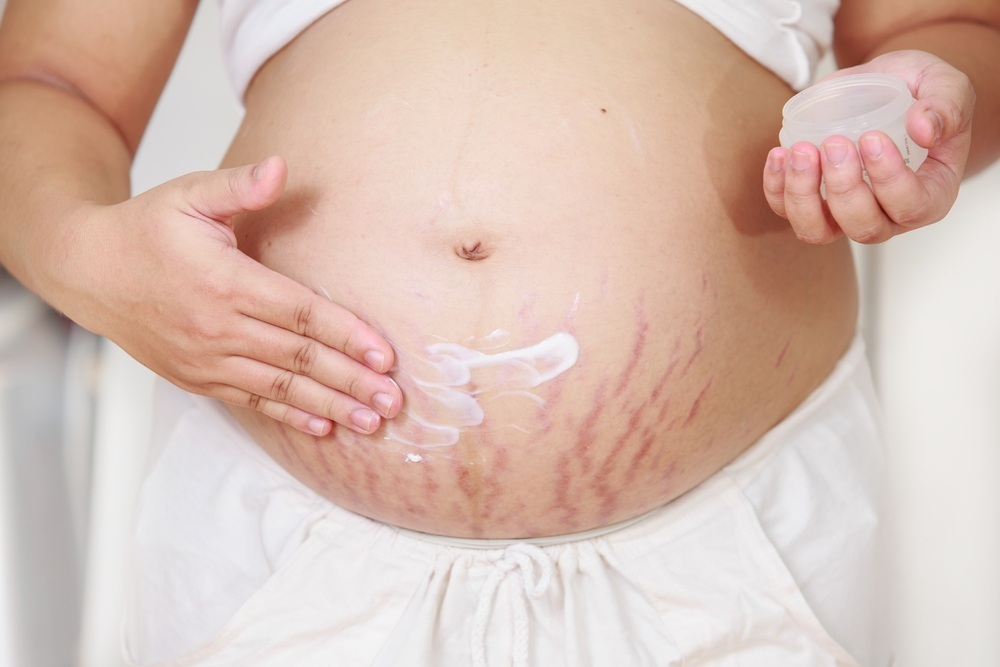 Mulher grávida passando creme sobre a pele com estrias - foto: baipooh/ShutterStock.com