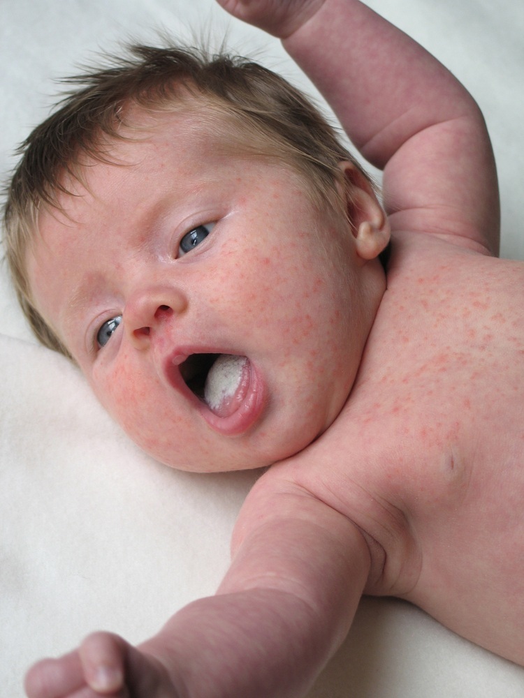 Bebê com a pele apresentando sinais alérgicos - foto: Glamorous Images/ShutterStock.com