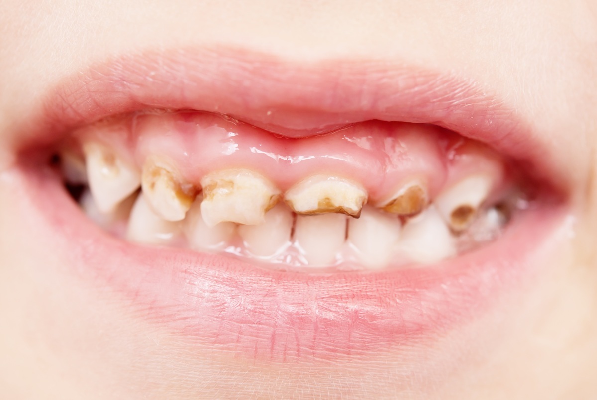 Dentes cariados na boca de uma criança - foto: NRT/ShutterStock.com