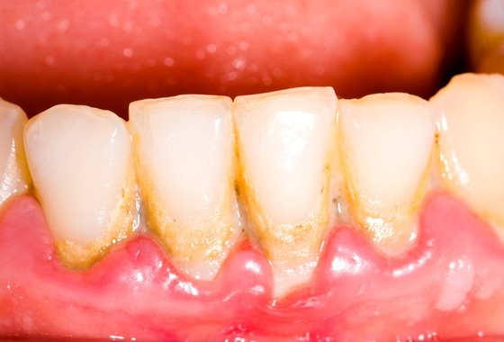 Dentição apresentando gengivite (inflamação das gengivas), além placa e tártaro - Foto: botazsolti/ShutterStock.com