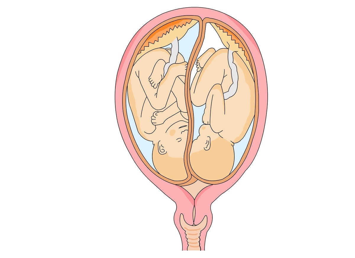 Bebês gêmeos na posição ideal no útero para o parto - foto: mmutlu/ShutterStock.com