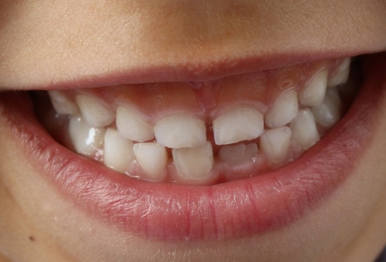 Mitos e verdades sobre a dentição de crianças - Foto: woodypino / pixabay.com