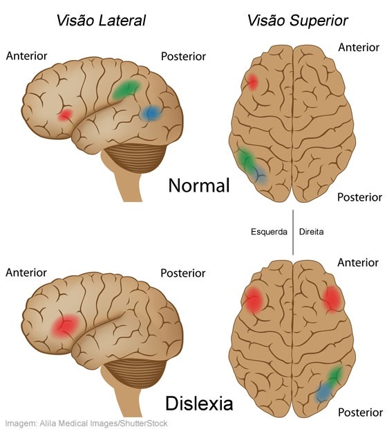 Atividade cerebral de uma pessoa com dislexia e sem dislexia - Imagem: Alila Medical Images/ShutterStock